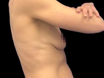 Before — The True Shape Breast Augmentation, Patient #15388
