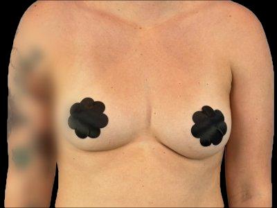 Before — The True Shape Breast Augmentation, Patient #71860