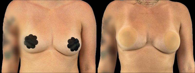 Patient #71860 Combined Image