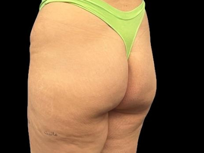 Before — True Curve BBL, Patient #71796