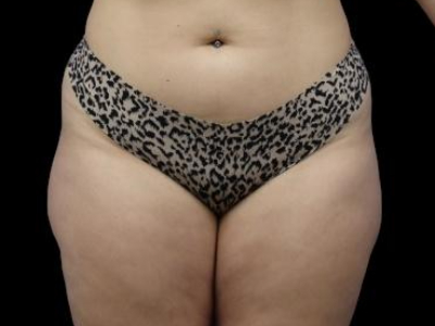 Before — True Curve BBL, Patient #21035