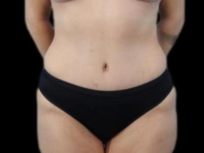 After — Tummy Tuck, Patient #40714