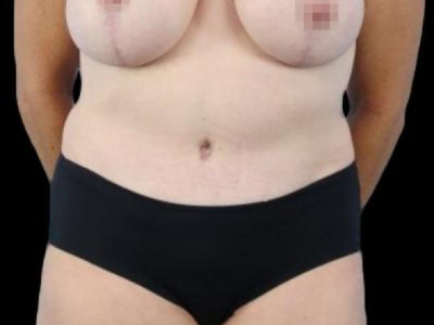 After — Tummy Tuck, Patient #94085