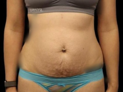 Before — Tummy Tuck, Patient #11643