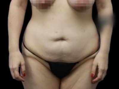 Before — Tummy Tuck, Patient #40714