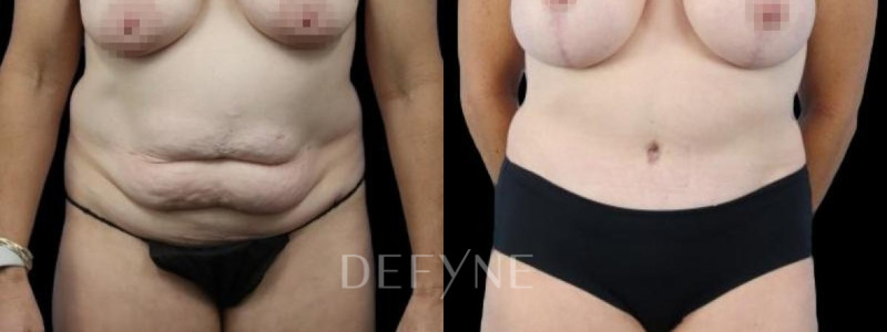 Patient #94085 Combined Image