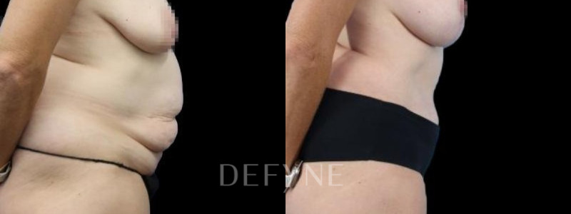 Patient #94085 Combined Image