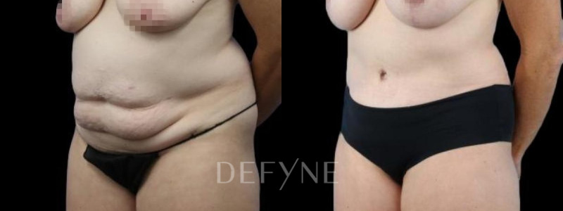 Patient #94085 Combined Image