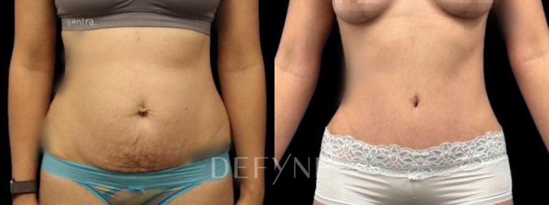 Patient #11643 Combined Image