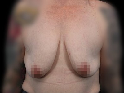 Before — Breast Augmentation, Patient #106998