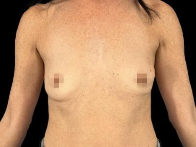 Before — Breast Augmentation, Patient #53462