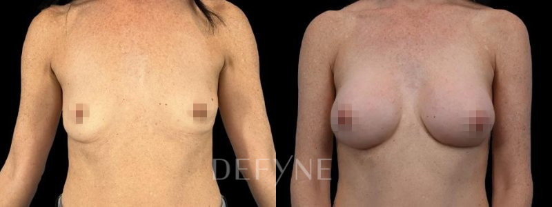 Patient #53462 Combined Image