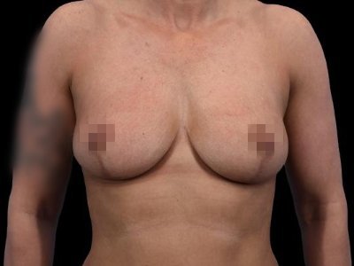 After — Breast Lift, Patient #96017