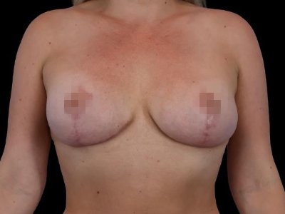 After — Breast Lift, Patient #22905