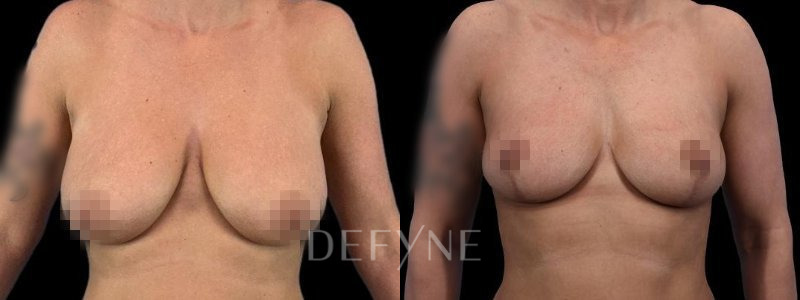 Patient #96017 Combined Image