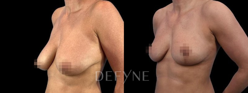 Patient #96017 Combined Image