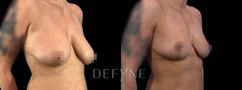 Patient #96017 Combined Image