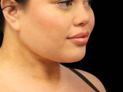 After — Chin Liposuction, Patient #104895, view 2