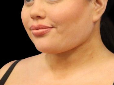 After — Chin Liposuction, Patient #104895, view 3