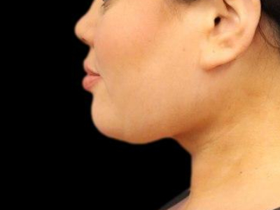 After — Chin Liposuction, Patient #104895, view 4