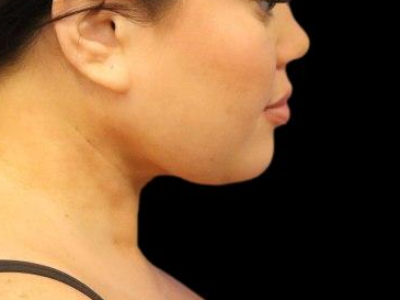 After — Chin Liposuction, Patient #104895