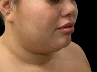 Before — Chin Liposuction, Patient #104895, view 2
