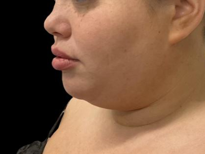Before — Chin Liposuction, Patient #104895, view 3