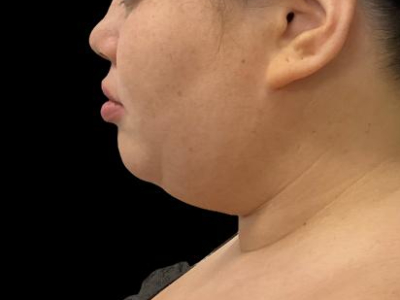 Before — Chin Liposuction, Patient #104895, view 4