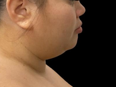 Before — Chin Liposuction, Patient #104895