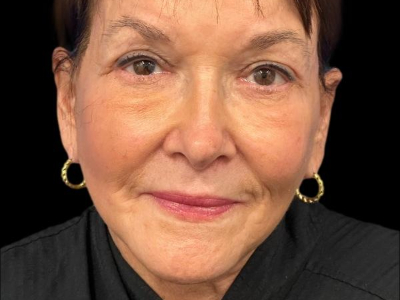 After — Facelift, Patient #101579