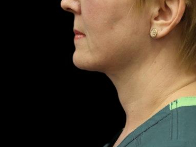 After — Neck Lift, Patient #51198