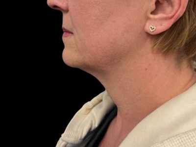 Before — Neck Lift, Patient #51198