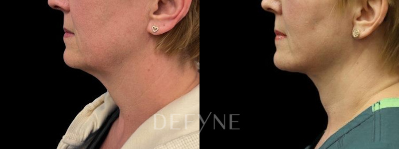 Patient #51198 Combined Image