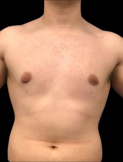 After — S.M.A.R.T. Core Contour, Patient #45563