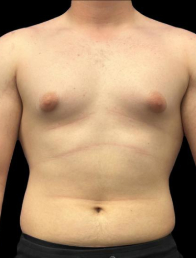 Before — S.M.A.R.T. Core Contour, Patient #45563