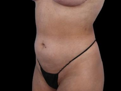After — S.M.A.R.T. Tummy Tuck, Patient #55814, view 2