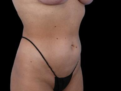 After — S.M.A.R.T. Tummy Tuck, Patient #55814, view 5