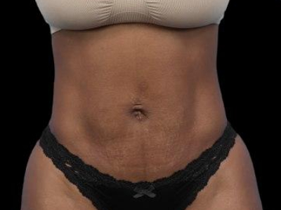 After — S.M.A.R.T. Tummy Tuck, Patient #70298