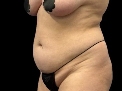 Before — S.M.A.R.T. Tummy Tuck, Patient #55814, view 2