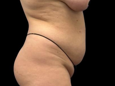 Before — S.M.A.R.T. Tummy Tuck, Patient #55814, view 3