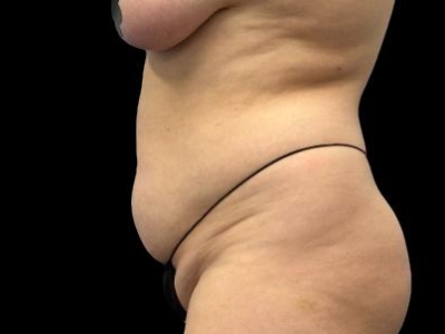 Before — S.M.A.R.T. Tummy Tuck, Patient #55814, view 4