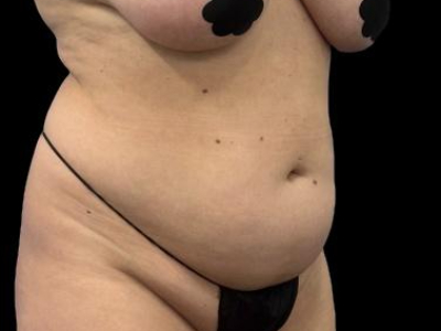 Before — S.M.A.R.T. Tummy Tuck, Patient #55814, view 5