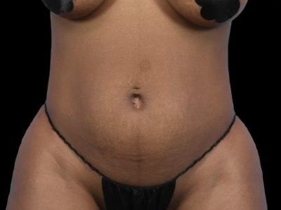 Before — S.M.A.R.T. Tummy Tuck, Patient #70298