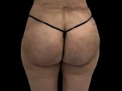 After — True Curve BBL, Patient #106886