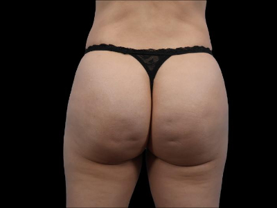 After — True Curve BBL, Patient #65632