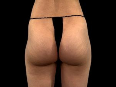 Before — True Curve BBL, Patient #23477
