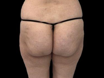 Before — True Curve BBL, Patient #106886