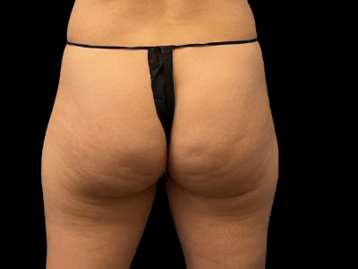 Before — True Curve BBL, Patient #65632