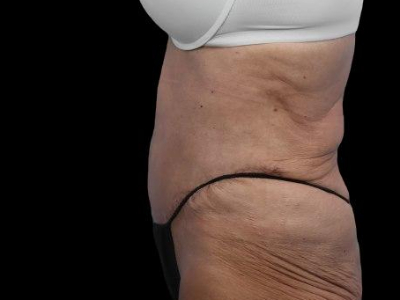 After — Tummy Tuck, Patient #59594