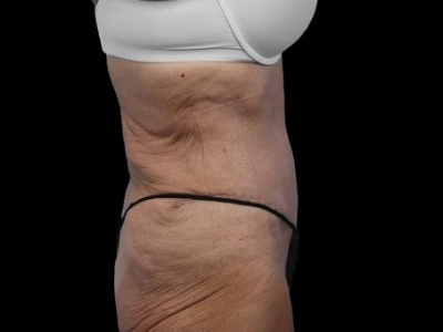 After — Tummy Tuck, Patient #59594, view 2